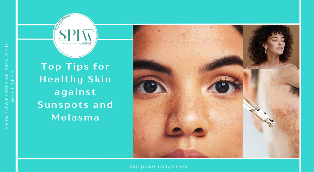 Sunspots and Melasma