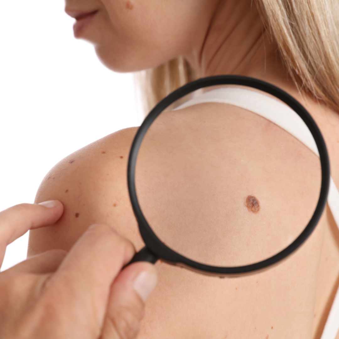 Skin tag examination on shoulder with magnifying glass, highlighting treatment area.