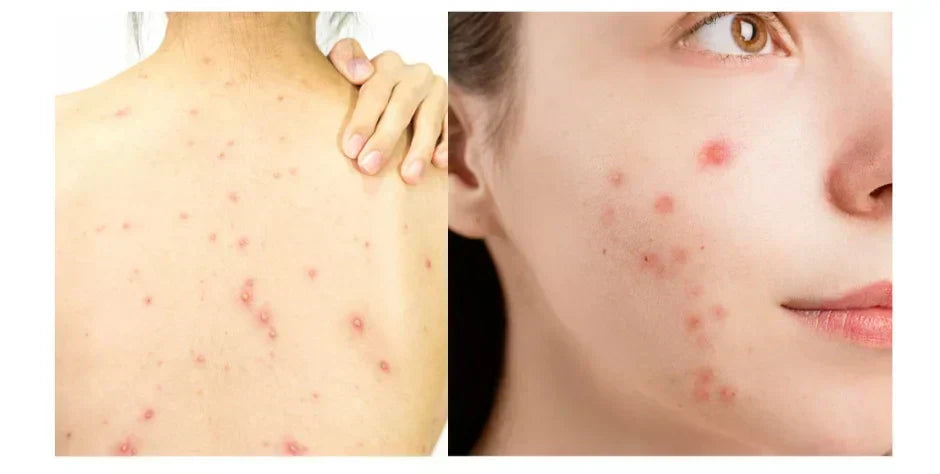 Secrets of Acne