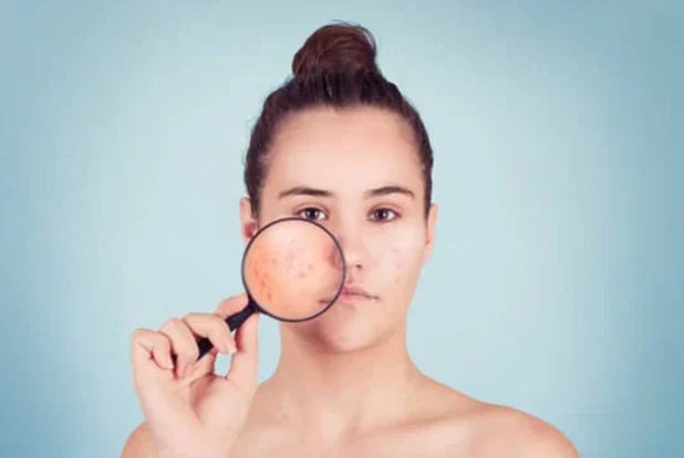 Acne-Skin Disorder