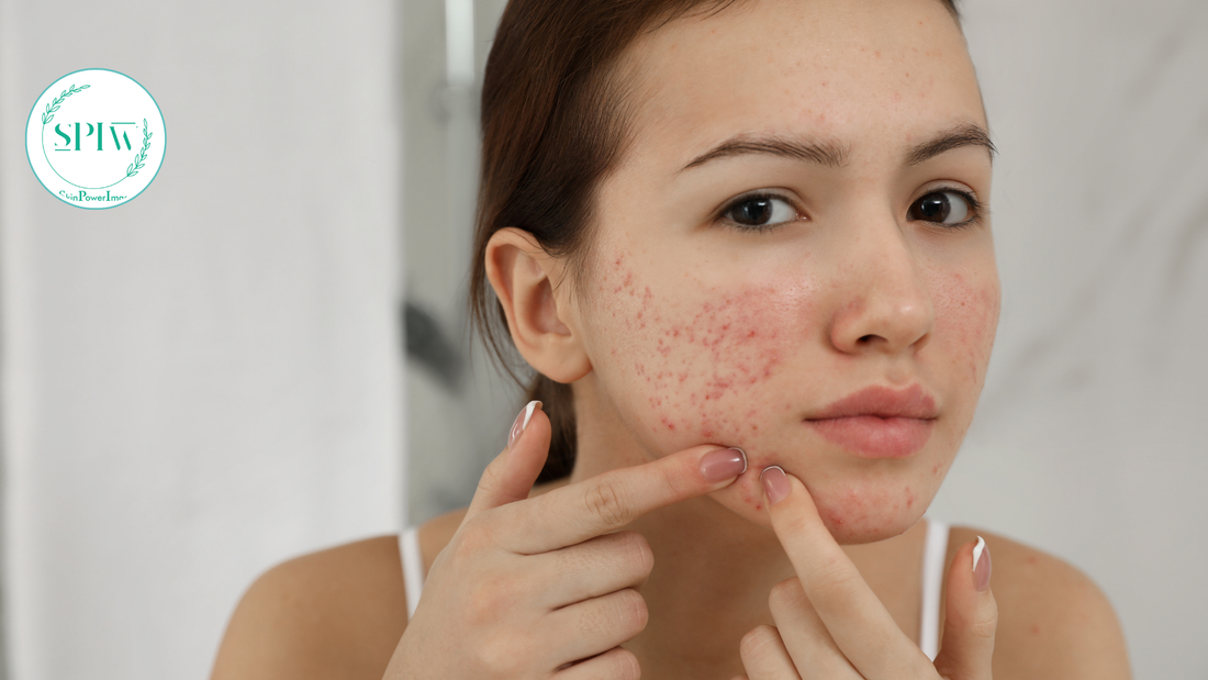 Understanding Acne: Causes, Treatments, and Smart Skincare Tip