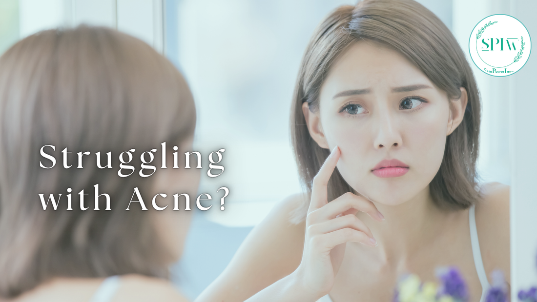 Struggling with Acne?
